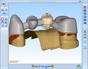 Screen shot from Renishaw's incise dental CAD software