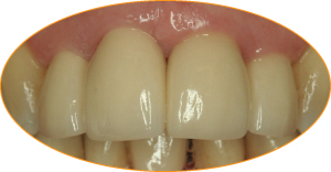 Case study 2_with incise crowns