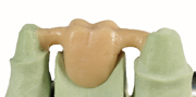 Waxed-up bridge pontic