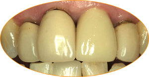 Case study 1_before incise crowns