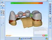 Screen shot from Renishaw's incise dental CAD software