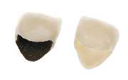 Inside a metal and ceramic crowns