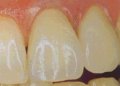 All-ceramic crowns