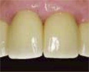 incise crowns