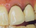 Metal bonded crowns