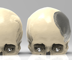 Cranioplasty: Pre and post surgery comparison
