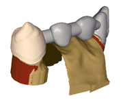 Adding material to an incise bridge