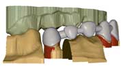 incise bridge showing bite index and adjacent teeth
