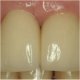 incise crowns fitted