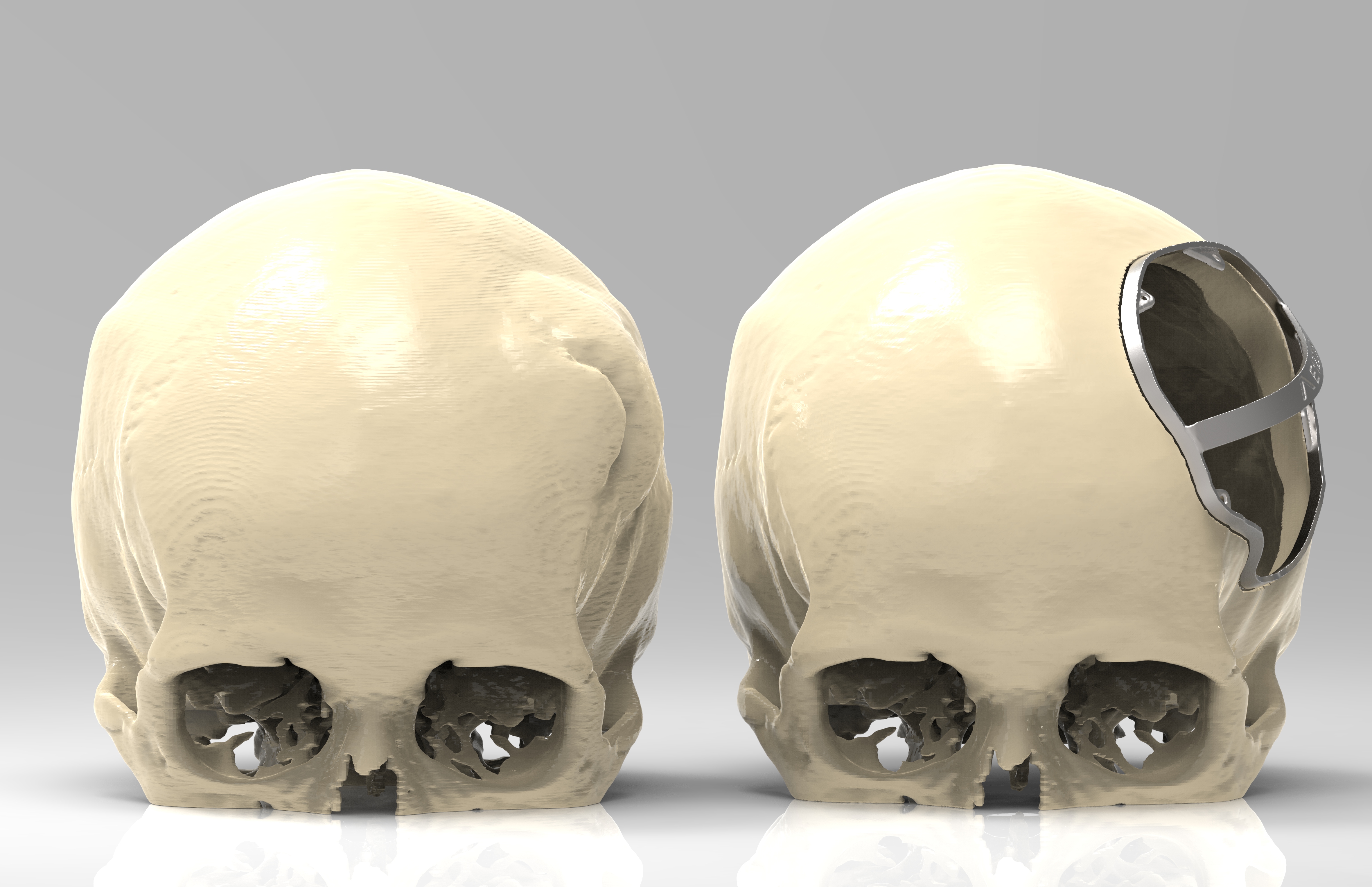После голова три. Краниопластика пластиной. Трепанация черепа титановая пластина. Краниопластика черепа операция. Пластика дефектов черепа (краниопластика).