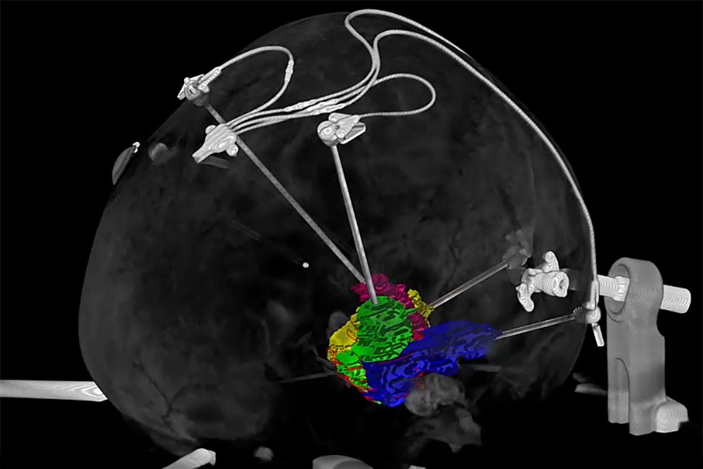 neuroinfuse plan in neuroinspire