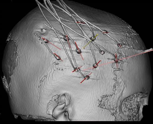 Visualizzazione degli elettrodi impiantati da parte del software di pianificazione chirurgica