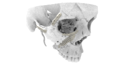 LaserImplant Facial implants