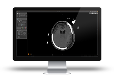 Automatische Daten-Koregistrierung von neuroinspire