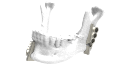 LaserImplant Mandibular cutting and drilling guides