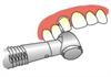 Dental CAD/CAM