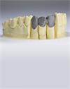 LaserPFM™ dental framework