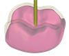 Provisional module crown transparent