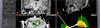 neuroinspire neurosurgical planning software