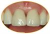 Case study - 2 incise crowns