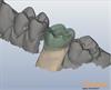 Dental crown design