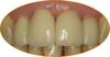 Case study 2_with incise crowns