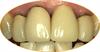 Case study 1_before incise crowns