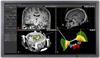 neuroinspire neurosurgical planning software