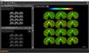 2D image of tibial tray taken from InfiniAM spectral software