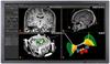 Neuroinspire neurosurgical planning software
