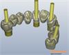 Implant bridge design RDS
