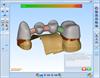 Screen shot from Renishaw's incise dental CAD software