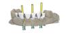 Implant bridge RDS transparent