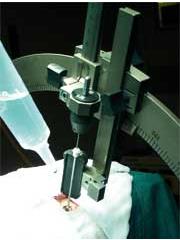 Inserting the neuro | guide electrode introducer kit guide tube which ...