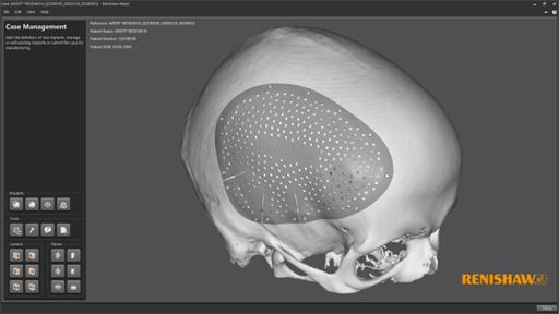 ADEPT-craniomaxillofacial design for 3D printing